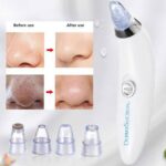 Derma suction Blackhead Remover